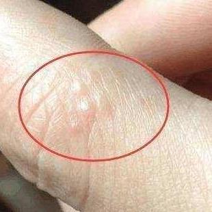 脚上起小水泡还很痒是怎么回事?一文读懂原因与应对方法 脚上起小水泡还很痒是怎么回事?一文读懂原因与应对方法